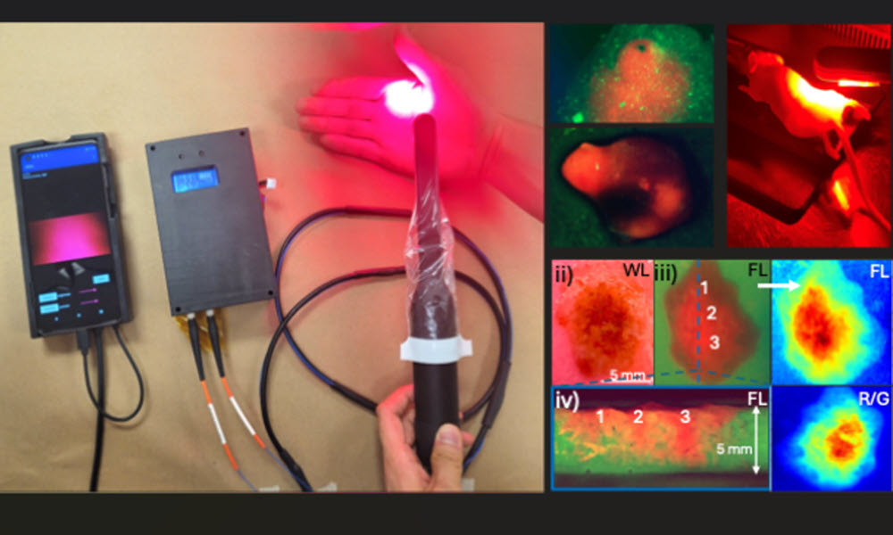 A newly developed intraoral device integrates diagnostic imaging and photodynamic therapy to detect and treat early-stage oral cancer. The handheld tool uses fluorescence imaging to identify lesions and delivers targeted light therapy to destroy cancerous tissue. Compact and affordable, it is designed for use in low-resource settings. Credit: Khan et al., doi 10.1117/1.BIOS.2.4.042305.