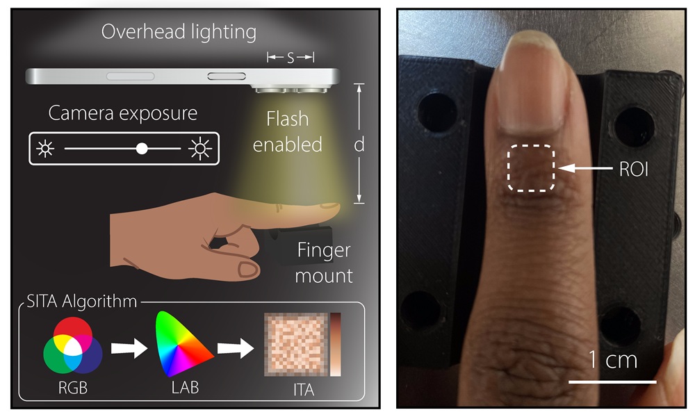 Proposed smartphone colorimeter measures at a common anatomical site (ROI) for pulse oximetry. By capturing images of the skin and calculating a standardized color metric known as the individual typology angle (ITA), the team showed that smartphones can produce accurate skin-tone readings comparable to those of expensive clinical devices. Image courtesy of J. A. Burrow (Morgan State and Brown University)