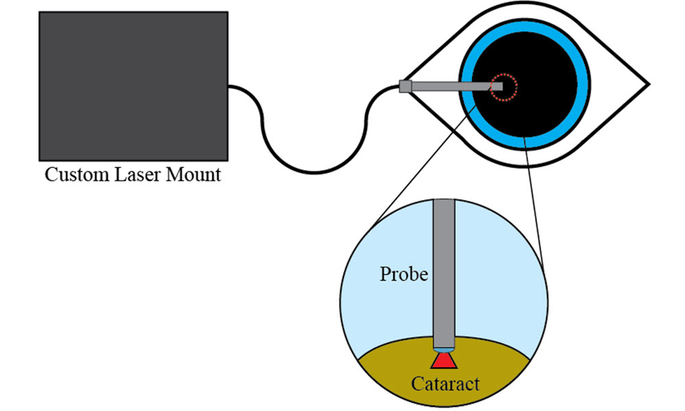 Laser phacoemulsification of cataracts uses a custom diode laser system to deliver the laser light directly to the target.