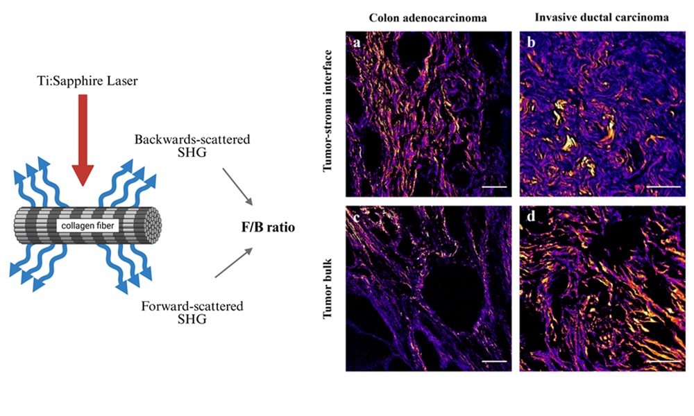 Researchers obtained second-harmonic-generation (SHG) images of more than 300 tumor samples
