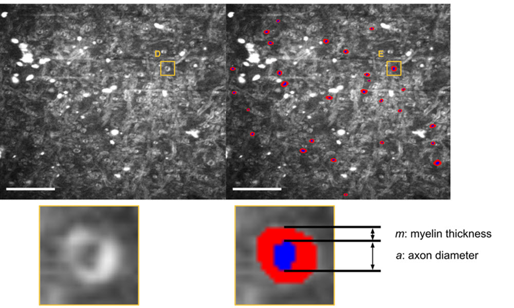 Composite grayscale microscopy images show nerve tissue with numerous bright circular structures; the right panel highlights detected axons marked by small red outlines. Insets below zoom into a single axon, with a schematic overlay labeling axon diameter (a) and surrounding myelin thickness (m).