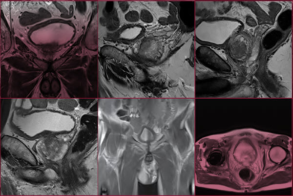 PROSTATEx images
